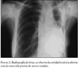 Radiografía de tórax, se observa la cavidad torácica abierta
