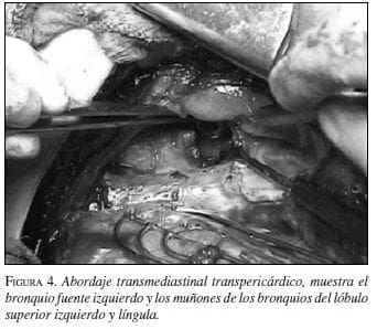 Abordaje transmediastinal transpericárdico