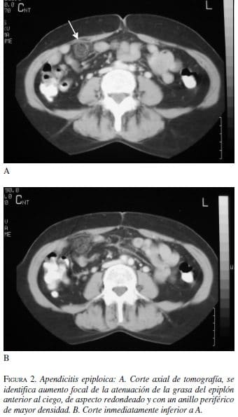Apendicitis Epiploica, tomografía y Corte inmediatamente inferior