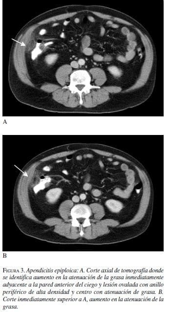 Apendicitis Epiploica, tomografía y Corte inmediatamente superior