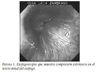 Esofagoscopia que muestra compresión extrínseca en el tercio Distal del Esófago