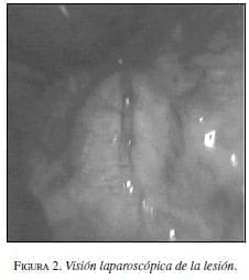Visión laparoscópica de la lesión