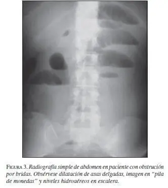 Radiografía simple de Abdomen en paciente con Obstrución por Bridas