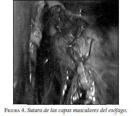Sutura de las capas musculares del Esófago