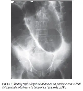 Radiografía simple de Abdomen en paciente con Vólvulo del Sigmoide