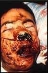 Herida en la cara por granada