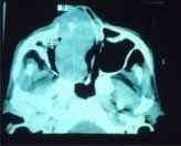 Tomografía computarizada en un corte axial