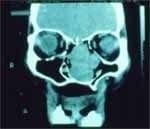 tomografía computarizada en un corte coronal