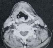 Carcinoma de laringe con destrucción del cartílago