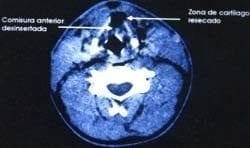 Tomografía de cartílago tiroides