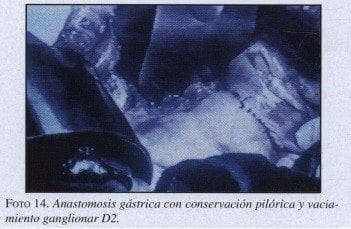 Anastomosis Gástrica con conservación Pilórica
