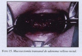 Mucosectomía transanal de adenoma velloso rectal