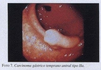 Carcinoma Gástrico temprano Antral tipo Ila