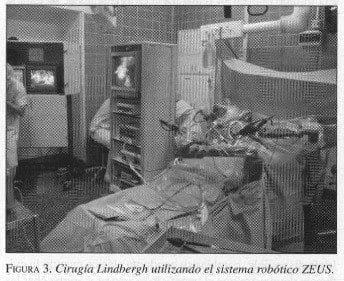Cirugía Lindbergh utilizando el sistema robótico ZEUS
