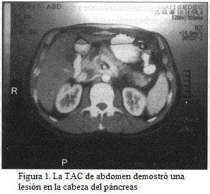 TAC de abdomen, lesión en la cabeza del páncreas