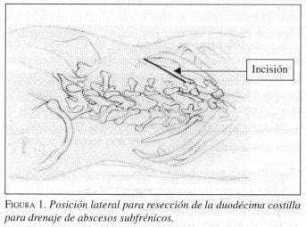Resección de la Duodécima costilla para drenaje de Abscesos Subfrénicos