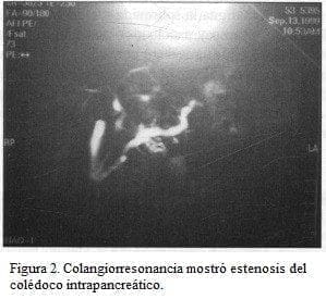 Colangiorresonancia, estenosis del colédoco intrapancreático