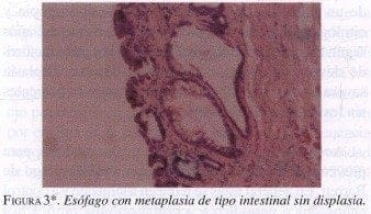 Esófago con Metaplasia de tipo Intestinal sin Displasia