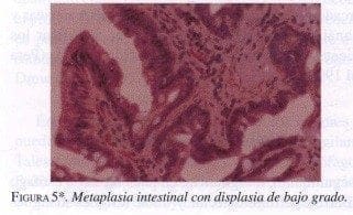 Metaplasia Intestinal con Displasia de bajo grado
