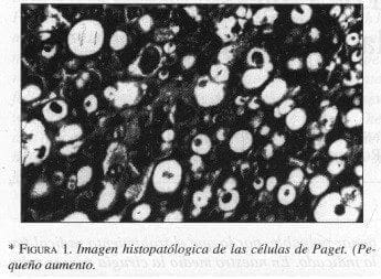 Imagen Histopatólogica de las células de Paget. (Pequeño aumento)