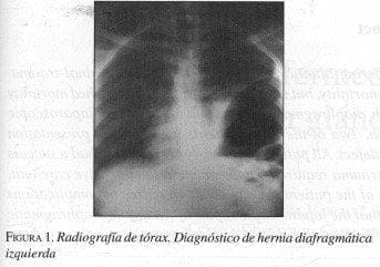 Radiografía de tórax. Diagnóstico de Hernia Diafragmática izquierda