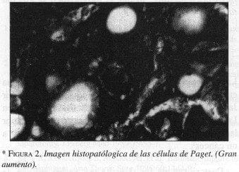 lmagen Histopatólogica de las células de Paget. (Gran aumento)