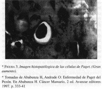 Imagen Histopatólogica de las células de Paget. (Gran aumento)