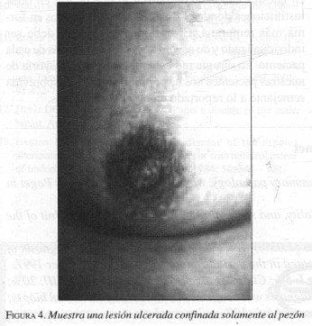 Lesión Ulcerada confinada solamente al Pezón