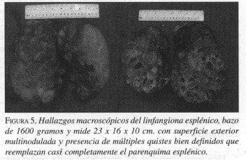Hallazgos Macroscópicos del linfangiona Esplénico