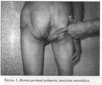 Hernia Perineal Primaria: Posición Ortostática