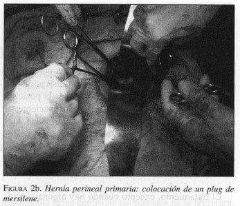 Hernia Perineal Primaria: colocación de un Plug de Mersilene