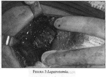 Seudotumor Inflamatorio de Hígado, Laparotomía