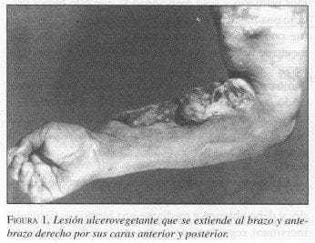 Lesión Ulcerovegelante