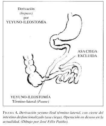 Derivación yeyuno-ileal término-lateral