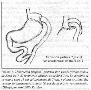 Derivación (bypass) Gástrica por gastro-yeyunostomía de Roux-en-Y
