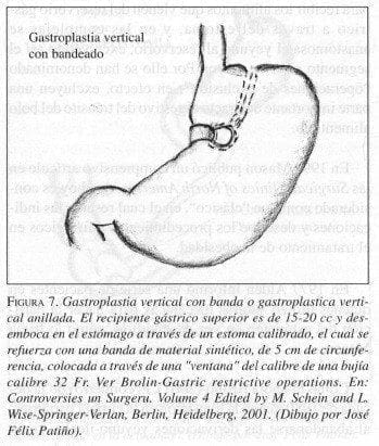 Gastroplastia Vertical con Banda o Gastroplastica vertical anillada