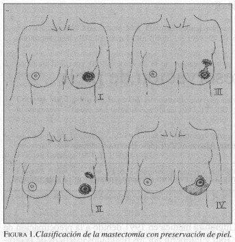Clasificación de la Mastectomía con preservación de piel