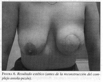 Mastectomía, Resultado Estético