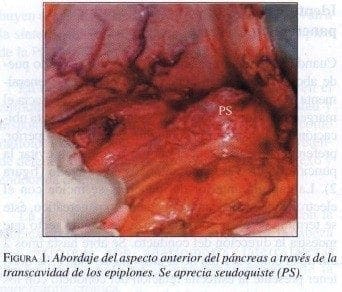 Abordaje del aspecto anterior del Páncreas a través de la Transcavidad de los Epiplones