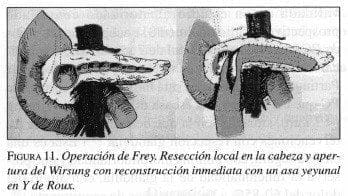 Operación de Frey
