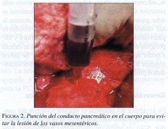 Punción del conducto Pancreático en el cuerpo