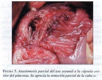 Anastomosis parcial del asa Yeyunal