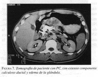 Tomografía de paciente con Pancreatitis Crónica