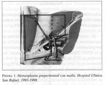 Hernioplastia Preperitoneal con Malla