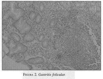 Gastritis Folicular