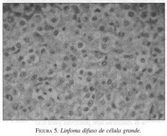 Linfoma difuso de célula grande