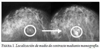 Localización de medio de Contraste mediante Mamografía