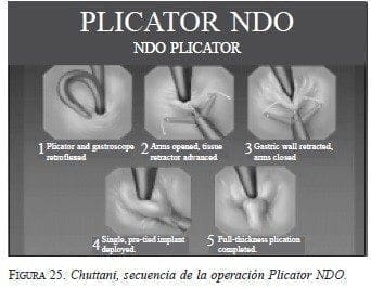 Chuttani, secuencia de la operación Plicator NDO