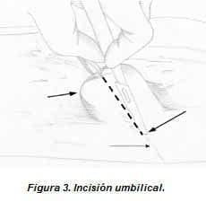 Incisión Umbilical