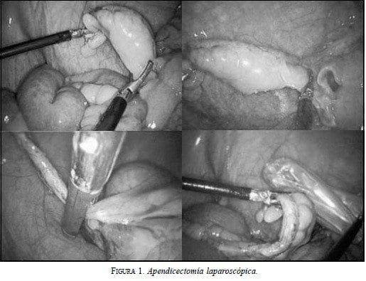 Apendicectomía Laparoscópica
